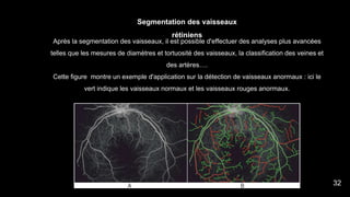 Après la segmentation des vaisseaux, il est possible d'effectuer des analyses plus avancées
telles que les mesures de diamètres et tortuosité des vaisseaux, la classification des veines et
des artères….
Cette figure montre un exemple d'application sur la détection de vaisseaux anormaux : ici le
vert indique les vaisseaux normaux et les vaisseaux rouges anormaux.
Segmentation des vaisseaux
rétiniens
32
 