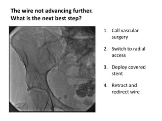 The wire not advancing further.
What is the next best step?
1. Call vascular
surgery

2. Switch to radial
access
3. Deploy covered
stent
4. Retract and
redirect wire

 