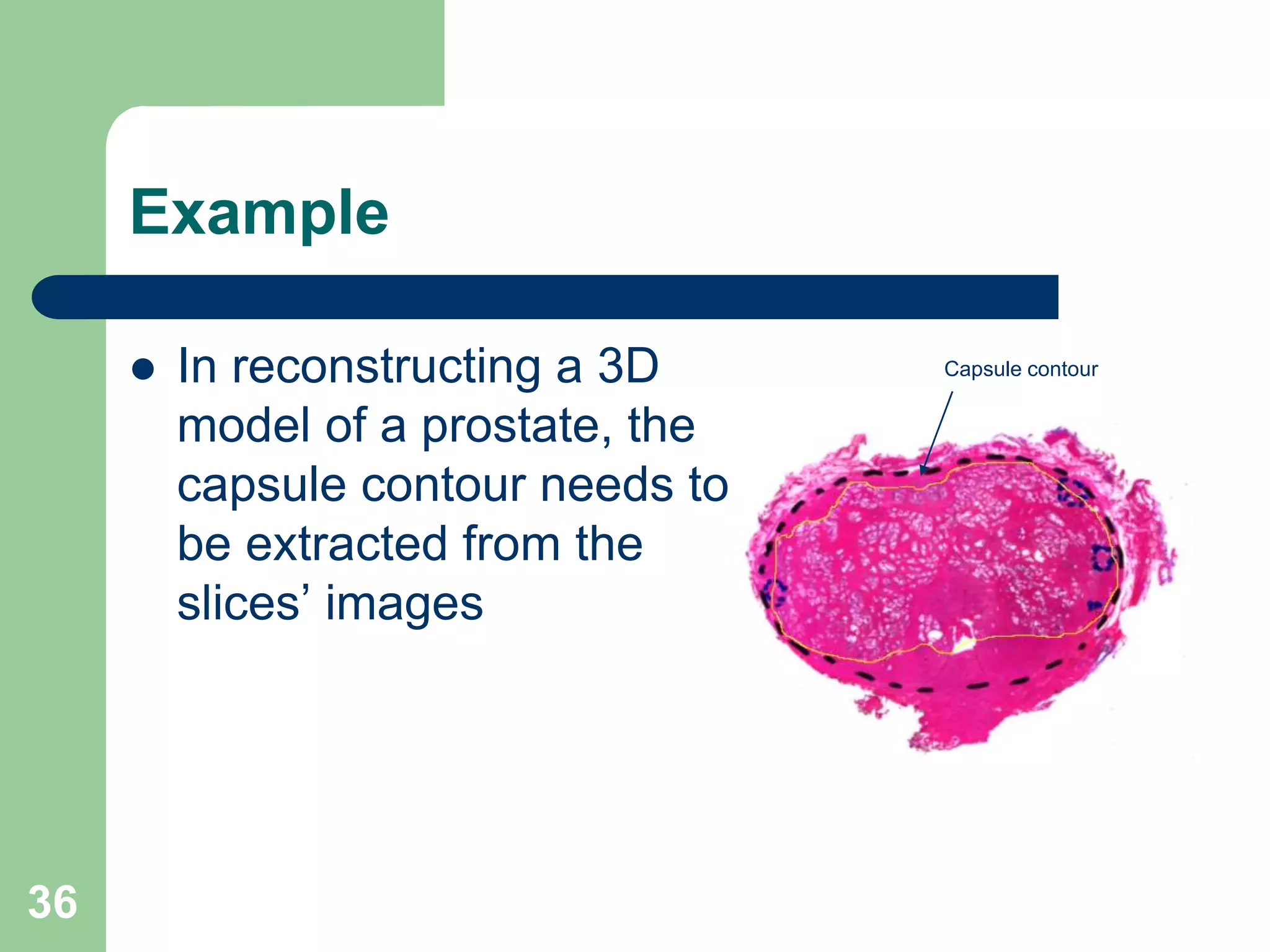 36
Example
 In reconstructing a 3D
model of a prostate, the
capsule contour needs to
be extracted from the
slices’ images
Capsule contour
 