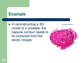 36
Example
 In reconstructing a 3D
model of a prostate, the
capsule contour needs to
be extracted from the
slices’ images
Capsule contour
 