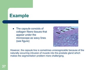 37
Example
 The capsule consists of
collagen fibers tissues that
appear under the
microscope as wavy lines
(see figure)
However, the capsule line is sometimes unrecognizable because of the
naturally occurring intrusion of muscle into the prostate gland which
makes the segmentation problem more challenging.
 