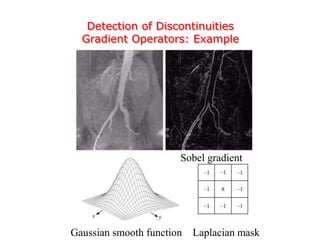 Detection of Discontinuities
Gradient Operators: Example
Sobel gradient
Laplacian maskGaussian smooth function
 