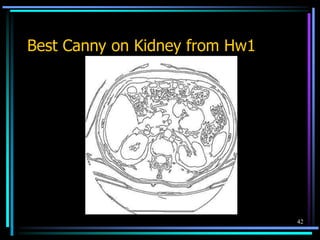 42
Best Canny on Kidney from Hw1
 