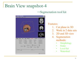 Brain View snapshot-4
                --Segmenation tool kit

                          Features:
                             1. Cut plane in 3D
                             2. Work in 2 data sets
                             3. 2D and 3D view
                             4. Segmenation
                                 methods:
                                 •   Morphology
                                 •   Snake
                                 •   Level Set
                                 •   Watershed


                                                  71
 