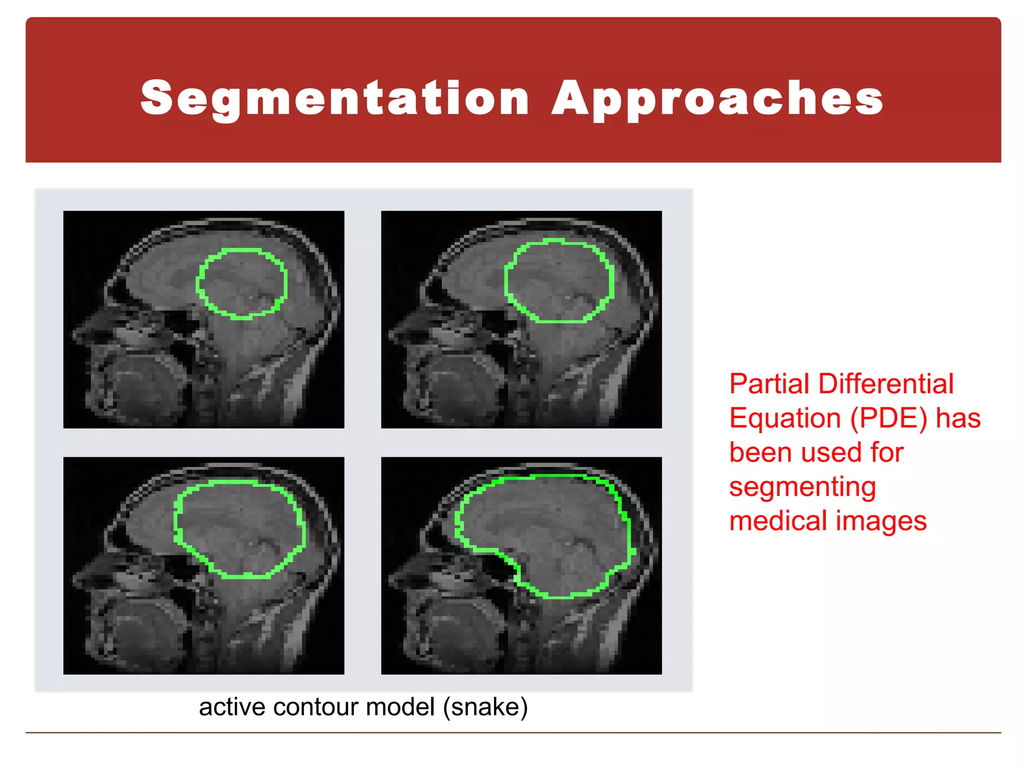 Segmentation Approaches




                                Partial Differential
                                Equation (PDE) has
                                been used for
                                segmenting
                                medical images




 active contour model (snake)
 