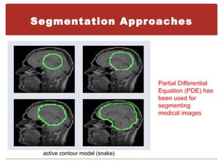 Segmentation Approaches




                                Partial Differential
                                Equation (PDE) has
                                been used for
                                segmenting
                                medical images




 active contour model (snake)
 