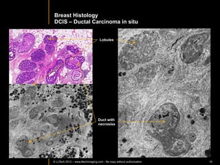 BREAST	
  AND	
  LYMPH	
  NODES	
  




© LLTECH 2011                                         10
 
