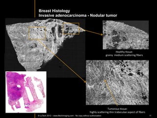 Healthy	
  breast	
  Issue	
                  Assayag	
  et	
  al,	
  TCRT	
  Express	
  2013	
  in	
  press	
  




              Grainy	
  aspect	
  of	
  normal	
      Duct	
  with	
        Lobule	
          Adipocytes	
                 Vessel	
  
                   ﬁbrous	
  Issue	
                 calciﬁcaIon	
  
©	
  LLTech	
  2012	
   © LLTECH 2011                                                                                Courtesy	
  of	
  Hôpital	
  Tenon,	
  Paris,	
  France	
  
                                                                                                                                                                         11
 