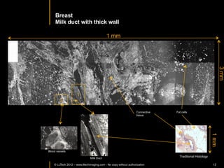 INVASIVE	
  ADENOCARCINOMA	
  :	
  	
  NODULAR	
  TUMOR	
  	
  


                                                                                         Interface	
  of	
  the	
  tumourous	
  and	
  
                                                                                         normal	
  appearing	
  	
  part	
  :	
  	
  


                                                                                       Diﬀerent	
  aspect	
  of	
  the	
  ﬁbrous	
  >ssue	
  	
  



                                                                                                                      Tumour	
  margin	
  


        500µm	
  
                                                           Highly	
  
                                                           scaHering	
  thin	
  
                                                           trabeculae	
  
                                                           aspect:	
  ﬁbrous	
  
                                                           >ssue	
  in	
  the	
  
                                                           tumourous	
  part	
                                                           100µm	
  




                                                                 Grey	
  zones	
  corresponding	
  to	
             Grainy	
  	
  
                                                                 foci	
  of	
  carcinomatous	
  cells	
             medium	
  
                                                                                                                    scaHering	
  
                                                                                                                    aspect:	
  healthy	
  
        500µm	
                                                 SENSITIVITY=	
  97%	
                               ﬁbrous	
  >ssue	
  	
  
©	
  LLTECH	
  2011	
     © LLTECH 2011                         SPECIFICITY=74%	
                                                                    12
 