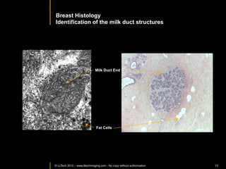 Normal	
  Sen>nel	
  Node	
  




                                                            Adipocytes	
  in	
  hilum	
  
Nodules	
  containing	
  
lymphoid	
  >ssue	
  




            © LLTECH 2011                  Capsule	
                                    13
 