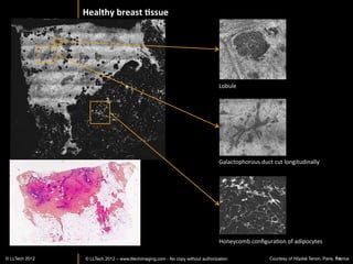 SENSITIVITY=	
  100%	
  
                                                 Invaded	
  Sen>nel	
  Node	
                  SPECIFICITY=97%	
  




                                                                         Invaded	
  zone	
  




Lymphoid	
  zone	
  




Bright	
  white	
  aspect,	
  
highly	
  scaHering	
  
dense	
  collagen	
  
meshwork	
  



Grieve	
  et	
  al	
  Proc	
  SPIE	
  2013	
  
                © LLTECH 2011                                                                                        14
 