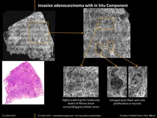 FF-­‐OCT	
  imaging	
  of	
  human	
  epilep>c	
  brain	
  and	
  cerebellum	
  iden>ﬁes	
  myelinated	
  
                         axon	
  ﬁbers,	
  a	
  subpopula>on	
  of	
  neuronal	
  cell	
  bodies	
  and	
  CNS	
  vasculature.	
  	
  

                        Cortex	
  


                                                                                                  Neuron	
  cell	
  bodies	
  (dark	
  dots)	
  

                 Axon	
  bundles	
  




                                                                                                          Axons/myelin	
  ﬁbers	
  	
  




                                                                                                                  Capillary	
  
                                                     White	
  maHer	
  

Harms	
  et	
  al	
  Proc	
  2011 2013	
  
               © LLTECH SPIE	
                                                                                                             16
 