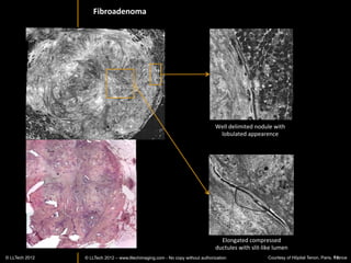 Hippocampus:	
  Coronal	
  sec>on	
  (led	
  side)	
  	
  




                                                           Sub-­‐	
  
                                                           Ependymal	
  	
  
                                                           zone	
  
  Pyramidal	
  neurons	
  of	
  the	
  CA4	
  ﬁeld	
  
  responsible	
  for	
  memory	
  
                                                                                              CA4	
  ﬁeld	
  

                                                         Alveus	
  

                                                               Stratum	
  radiatus	
  	
  
                                                                                                                  Hippocampal	
  sulcus	
  
                                                               of	
  the	
  CA1	
  ﬁeld	
  




Stratum	
  granulosum	
  of	
  the	
  dentate	
  gyrus	
                                        CA1	
  ﬁeld	
  of	
  the	
  cornus	
  ammonis	
  




             © LLTECH 2011                                                                                                                   17
 