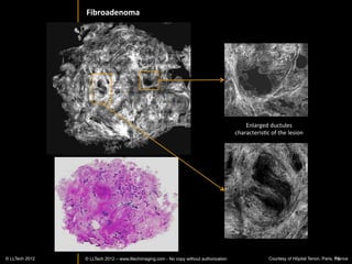 FF-­‐OCT	
  images	
  dis>nguish	
  meningiomas	
  from	
  meningeal	
  
                               haemangiopericytoma	
  

 Meningioma	
  psammoma	
  –	
  diagnosis	
  possible	
  directly	
  on	
  FF-­‐OCT	
  image	
  
                                                                                                            Collagen	
  bundles	
  




                                                                                                                  Whorls	
  




                                                                                                                CalciﬁcaIon	
  




80%	
  of	
  meningiomas	
  are	
  benign.	
                                                                 Collagen	
  balls	
  
	
  
Histologically,	
  meningioma	
  cells	
  are	
  relaIvely	
  uniform,	
  with	
  a	
  tendency	
  to	
  encircle	
  one	
  another,	
  
forming	
  whorls	
  and	
  psammoma	
  bodies	
  (laminated	
  calciﬁc	
  concreIons).They	
  have	
  a	
  tendency	
  to	
  
calcify	
  and	
  are	
  highly	
  vascularized.	
  Areas	
  of	
  ﬁbrosis	
  may	
  be	
  present.	
                              18
            © LLTECH 2011
 