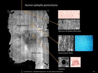 Skin	
  pathologies:	
  basal	
  cell	
  carcinoma	
  discriminaIon	
  at	
  
                                      structural	
  level	
  




      Dense	
  peritumoral	
  stroma	
  




© LLTech 2012 © LLTECH 2011                                                       Courtesy of Hopitaux Universitaires de Genève, Genève, Switzerland
                                                                                                                                                 26
 