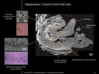 Zoom	
  on	
  basal	
  cell	
  carcinoma:	
  discriminaIon	
  at	
  cellular	
  level	
  



                                                                                                  Peritumoral	
  stroma	
  




                                                                                                                                     High	
  cell	
  density	
  




                                                                               200	
  µm	
  



                                                                                                                                                                100	
  µm	
  




©	
  LLTech	
  2012	
   © LLTECH 2011                                                          Courtesy	
  of	
  Hopitaux	
  Universitaires	
  de	
  Genève,	
  Genève,	
  Switzerland	
  
                                                                                                                                                                                   27
 