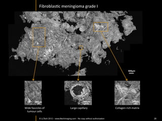 Skin	
  in-­‐vivo:	
  ﬁngerprint	
  imaging	
  in	
  3D	
  	
  	
  




                                                                                         Fingerprints	
  	
  3D	
  reconstrucIon	
  
                                                                                             FOV	
  800	
  µm	
  x	
  800	
  µm	
  

Sweat	
  ducts	
  



                                                                       Corneocytes	
  
                                                                                              LightCT	
  arm	
  support	
  add-­‐
                                                                                              on	
  allows	
  in	
  vivo	
  imaging	
  
                                                              100 µm                          on	
  arm,	
  hand,	
  ﬁngers	
  
                        En-­‐face	
  image	
  of	
  ﬁngerprints	
  



        © LLTECH 2011                                                                                                                     28
 