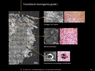 Skin	
  in-­‐vivo:	
  skin	
  layers	
  imaging	
  en	
  face	
  and	
  in	
  verIcal	
  
                           reconstrucIon	
  




                                Stratum	
  corneum	
               Stratum	
  spinosum	
                           Dermis	
  



Stratum	
  corneum	
  

Stratum	
  spinosum	
  


             Dermis	
                                                                        100	
  µm	
     EvaluaIon	
  of	
  stratum	
  
                                                                                                              corneum	
  thickness:	
  	
  
                                                                                                                    15	
  µm	
  




           © LLTECH 2011                                                                                                                      29
 