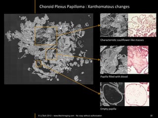 Mouse	
  skin	
  in	
  vivo	
  
                                                                          20um	
  depth	
  
                                                                                                 En-­‐face	
  slices	
  in	
  thigh	
  region	
  
                                              10um	
  depth	
  
                                                                                                 FOV	
  1mm2	
  
                                                                                                 PenetraIon	
  to	
  200um	
  
                                                                                                 	
  




   Hairs	
  near	
  surface	
  




                                              35um	
  depth	
             85um	
  depth	
  




    Hair	
  follicles	
  
                                                                                              Collagen	
  ﬁbers	
  



©	
  LLTech	
  2012	
   © LLTECH 2011                                                                       Courtesy	
  of	
  InsItut	
  Langevin,	
  Paris,	
  France	
  
                                                                                                                                                                   30
 