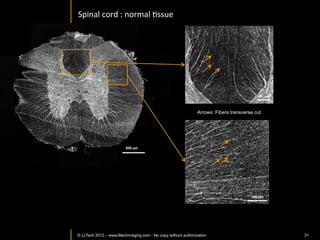 LUNG	
  




© LLTECH 2011              31
 