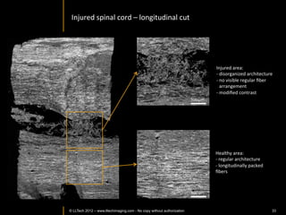 Image	
  from	
  non-­‐neoplasIc	
  human	
  lung	
  Issue	
  




                   Collapsed	
  lung	
  




                                                                      Alveoli	
  
                             Blood	
  vessel	
  


FOV:	
  FFOCT	
  ~	
  4	
  mm	
  x	
  4	
  mm;	
  H&E	
  =	
  4X	
  	
  


             Jain	
  et	
  al.	
  Pathology	
  Visions	
  2013.	
  	
  
      © LLTECH 2011                                                                                   33
 