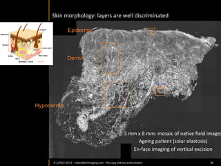 Glomerulus	
  
              Image	
  from	
  non-­‐neoplasIc	
  kidney	
  Issue	
  

                                          Glomerulus	
  
                                                                             Blood	
  vessel	
  


                                                                                                   3xzoom	
  (FOV	
  ~0.19x0.19	
  mm)	
  
                                                                            Tubules	
              	
  
                                                                                                                  Tubules	
  




                                                                                                    3x	
  zoom	
  (FOV	
  ~0.19x0.19	
  mm)	
  
                                                                                                                          	
  
                                                                                                            Blood	
  vessel	
  




FFOCT:	
  FOV~	
  0.37x0.25	
  mm,	
  depth	
  of	
  imaging	
  0.1um	
  


                        Caron	
  et	
  al.	
  Proc	
  SPIE	
  2013	
  
© LLTECH 2011                                                                                        3x	
  zoom	
  (FOV	
  ~0.19x0.19	
  mm)	
   36
 