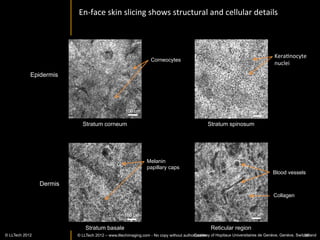 NeoplasIc	
  kidney:	
  normal	
  architecture	
  replaced	
  by	
  sheets	
  of	
  cells	
  




                                                                                                       Sheets	
  of	
  cells	
  	
  


                                       Sheets	
  of	
  cells	
  	
  




                                                   Sheets	
  of	
  cells	
  	
  


       FFOCT:	
  FOV	
  ~	
                                                        H&E	
  10X	
  
0.38x0.38	
  mm,	
  depth	
  
 of	
  imaging	
  :	
  7.2um	
  


                      3x	
  zoom	
  (FOV~	
  
                      0.19x0.19mm)	
  
           © LLTECH 2011                               Chromophobe	
  RCC	
                               20X	
  
                                                                                                                                       38
 