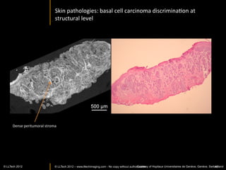 Large	
  ﬁeld	
  en	
  face	
  view	
  of	
  epithelial	
  layer	
  




                                                                                                                              100	
  um	
  



                                                                                               LightCT	
  can	
  evaluate	
  
                                                                                               integrity	
  of	
  epithelium	
  
                                                                                               and	
  stroma	
  in	
  graa	
  
                                                                                               corneas	
  (not	
  possible	
  
                                                                                               with	
  exisIng	
  techniques)	
  

                                                                                         200	
  um	
  

www.lltechimaging.com
          © LLTECH 2011                                                                                         Courtesy of Vincent Borderie
                                                                                                                                        42
 