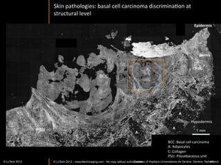 Large	
  ﬁeld	
  en	
  face	
  view	
  in	
  stroma	
  



200	
  um	
  




                                                                                    ApplcaIon	
  of	
  LightCT	
  
                                                                                    in	
  eye	
  banks	
  




www.lltechimaging.com
          © LLTECH 2011                                                                    Courtesy of Vincent Borderie
                                                                                                                   43
 