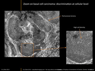 LightCT	
  shows	
  corneal	
  pathology	
  and	
  can	
  penetrate	
  even	
  
                      edematous	
  cornea	
  




                                                                       Cornea	
  with	
  edema



Cornea	
  with	
  chemical	
  burn	
  –	
  
highly	
  sca]ering	
  upper	
  stroma	
  


  © LLTECH 2011                                                                                         44
 