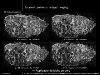 Core	
  Needle	
  Biopsy:	
  Kidney	
  



    LightCT	
  provides	
  an	
  evaluaIon	
  of	
  Issue	
  architecture	
  in	
  minutes	
  	
  




                                                                                                                                               100µm


                                                                                                      Renal	
  tubules	
  


                                                                                              500µm




                                                                                                                                                 50µm



                                                                                                        Vessel	
  




©	
  LLTech	
  2012	
   © LLTECH 2011                                                                         Courtesy	
  of	
  InsItut	
  Curie,	
  Paris,	
  France	
  
                                                                                                                                                                  46
 