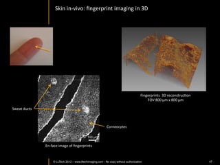 Core	
  Needle	
  Biopsy	
  
                                        Breast:	
  InﬁltraIve	
  carcinoma	
  




     LightCT	
  used	
  intraoperaIvely	
  on	
  biopsy	
  Issue	
  provides	
  fast,	
  non	
  destrucIve	
  evaluaIon	
  




©	
  LLTech	
  2012	
   © LLTECH 2011                                                                   Courtesy	
  of	
  InsItut	
  Curie,	
  Paris,	
  France	
  
                                                                                                                                                            47
 