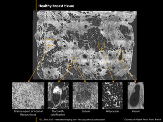 Light	
  CT	
  technology	
  


Based	
  on	
  Full-­‐Field	
  OpIcal	
  Coherence	
  Tomography	
  (FFOCT)	
  
Combines	
  microscope	
  resoluIon	
  with	
  interferometry	
  
High	
  resoluIon	
  in-­‐depth	
  C	
  scans	
  
	
  


       Commercial	
  device	
  specs:	
  
       •    Excellent	
  resoluIon:	
  1.5µm	
  transverse,	
  1µm	
  axial	
  
       •    70Hz	
  max.	
  tomographic	
  frame	
  rate	
  –	
  0.8	
  mm	
  x	
  0.8	
  mm	
  
       •    PenetraIon	
  depth	
  200µm	
  –	
  1mm	
  depending	
  on	
  Issue	
  sca]ering	
  
       •    25	
  mm	
  diameter	
  sample	
  size	
  
       •    Small	
  footprint:	
  Scanner	
  and	
  light	
  source	
  ﬁt	
  on	
  70	
  cm	
  x	
  35	
  cm	
  	
  
 