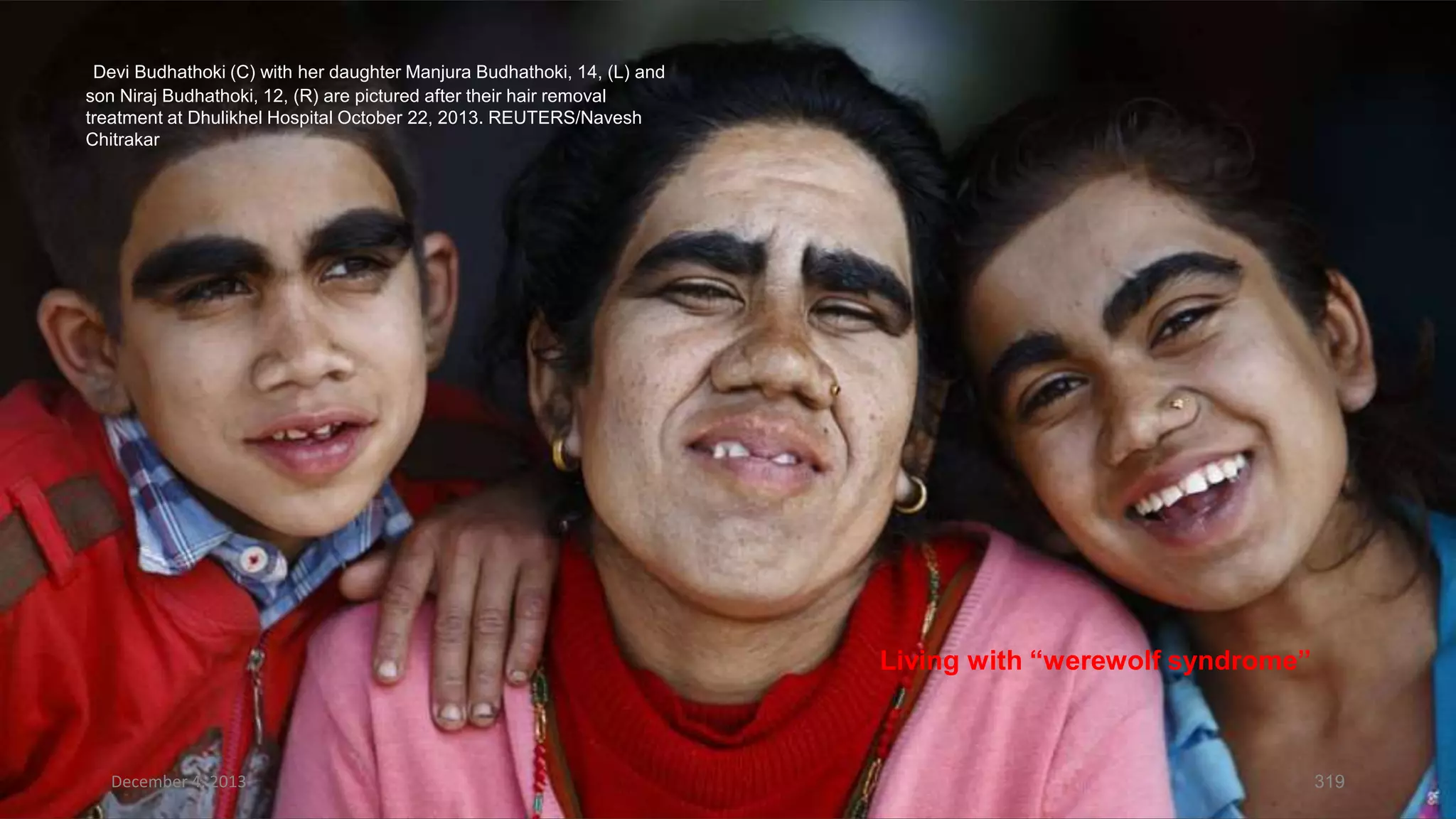 Devi Budhathoki (C) with her daughter Manjura Budhathoki, 14, (L) and
son Niraj Budhathoki, 12, (R) are pictured after their hair removal
treatment at Dhulikhel Hospital October 22, 2013. REUTERS/Navesh
Chitrakar

Living with “werewolf syndrome”

December 4, 2013

319

 