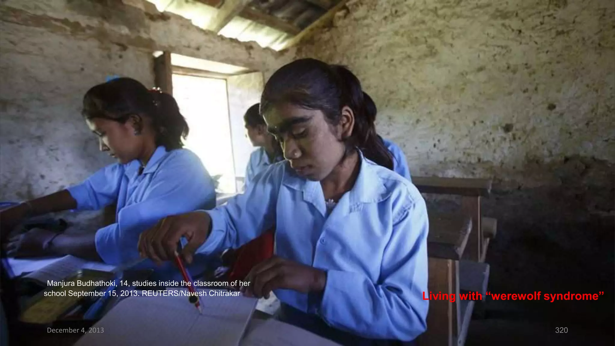 Manjura Budhathoki, 14, studies inside the classroom of her
school September 15, 2013. REUTERS/Navesh Chitrakar

December 4, 2013

Living with “werewolf syndrome”
320

 