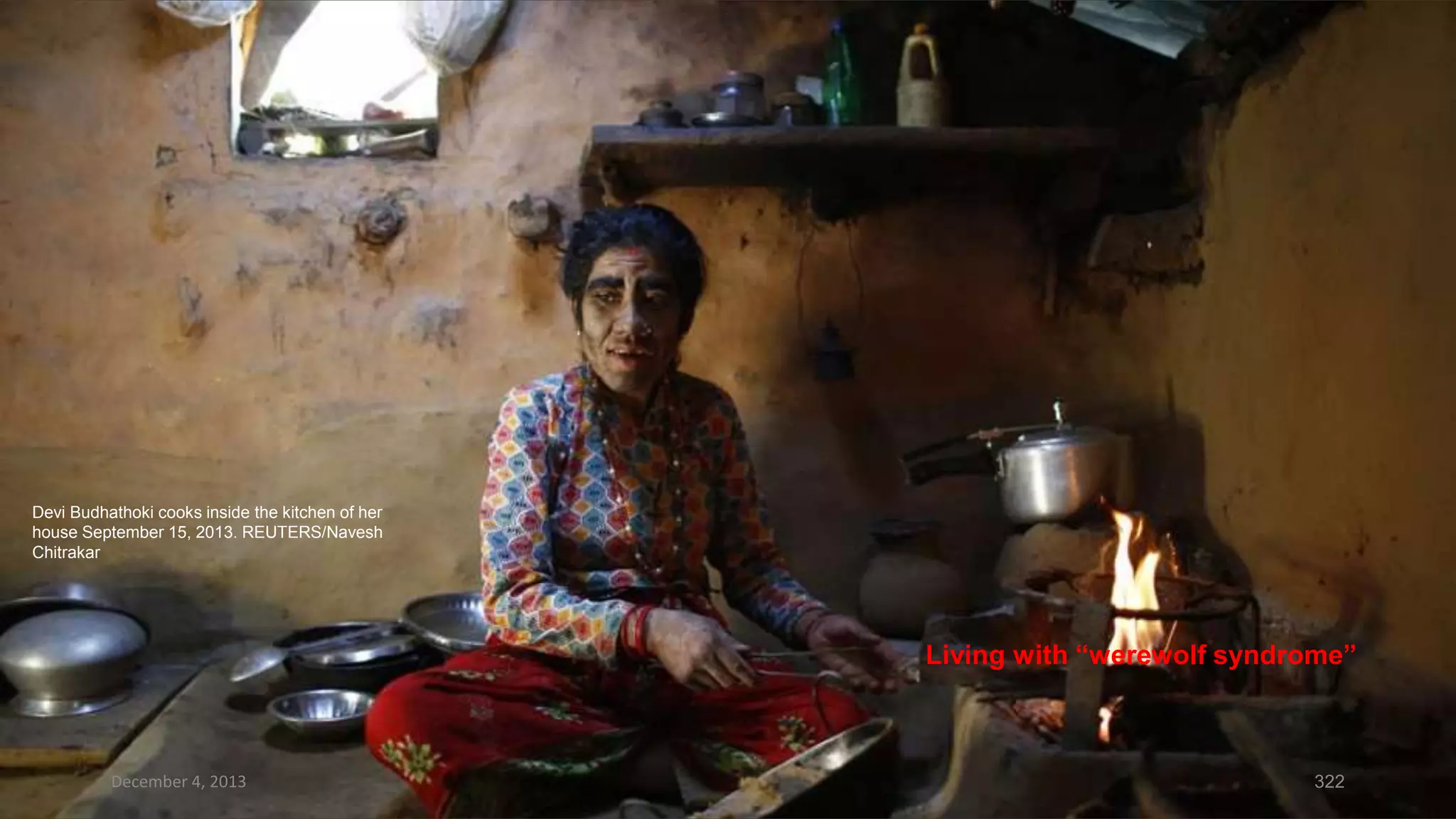 Devi Budhathoki cooks inside the kitchen of her
house September 15, 2013. REUTERS/Navesh
Chitrakar

Living with “werewolf syndrome”

December 4, 2013

322

 