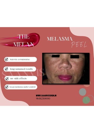 Melasma