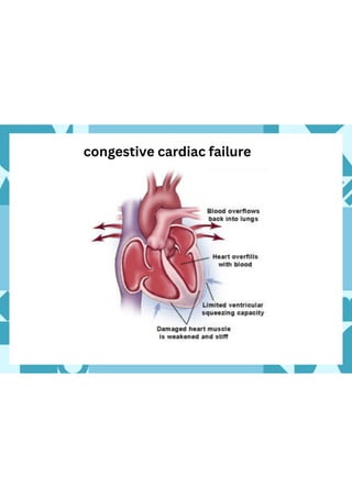 CONGESTIVE CARDIAC FAILURE| CCF|PPT|PPTX | PDF