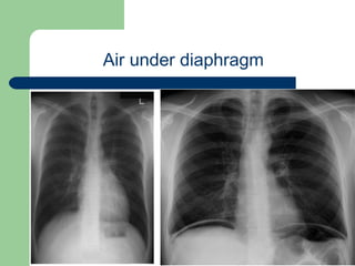 University of
Alexandria
Air under diaphragm
 