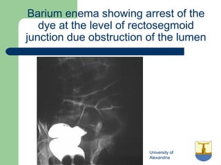 University of
Alexandria
Barium enema showing arrest of the
dye at the level of rectosegmoid
junction due obstruction of the lumen
 