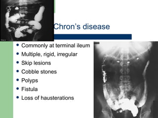 University of
Alexandria
Chron’s disease
 Commonly at terminal ileum
 Multiple, rigid, irregular
 Skip lesions
 Cobble stones
 Polyps
 Fistula
 Loss of hausterations
 