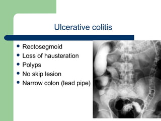 University of
Alexandria
Ulcerative colitis
 Rectosegmoid
 Loss of hausteration
 Polyps
 No skip lesion
 Narrow colon (lead pipe)
 