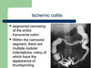 University of
Alexandria
Ischemic colitis
 segmental narrowing
of the entire
transverse colon.
 Within the narrowed
segment, there are
multiple nodular
indentations, many of
which have the
appearance of
thumbprinting
 