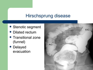 University of
Alexandria
Hirschsprung disease
 Stenotic segment
 Dilated rectum
 Transitional zone
(funnel)
 Delayed
evacuation
 