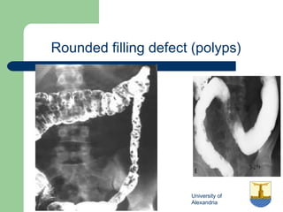 University of
Alexandria
Rounded filling defect (polyps)
 