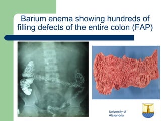 University of
Alexandria
Barium enema showing hundreds of
filling defects of the entire colon (FAP)
 