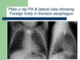 University of
Alexandria
Plain x ray PA & lateral view showing
Foreign body in thoracic esophagus
 