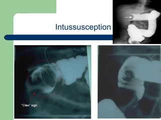 University of
Alexandria
Intussusception
 