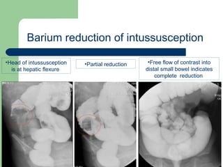 University of
Alexandria
Barium reduction of intussusception
•Head of intussusception
is at hepatic flexure
•Free flow of contrast into
distal small bowel indicates
complete reduction
•Partial reduction
 