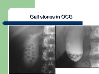 University of
Alexandria
Gall stones in OCGGall stones in OCG
 
